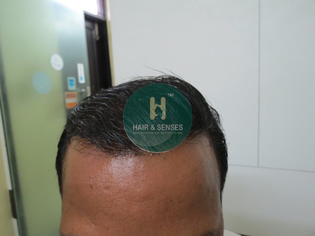 Hair Transplant Case Study